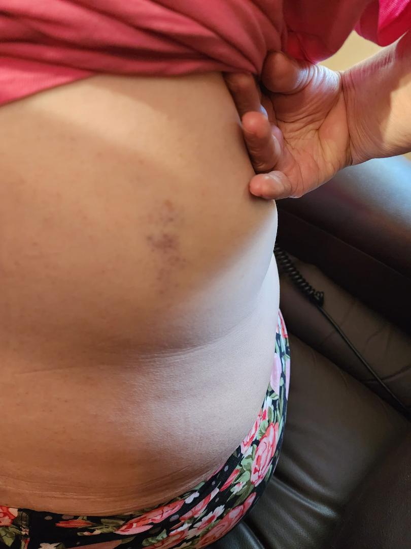 A bruise on my Back. Neither side is really tender.