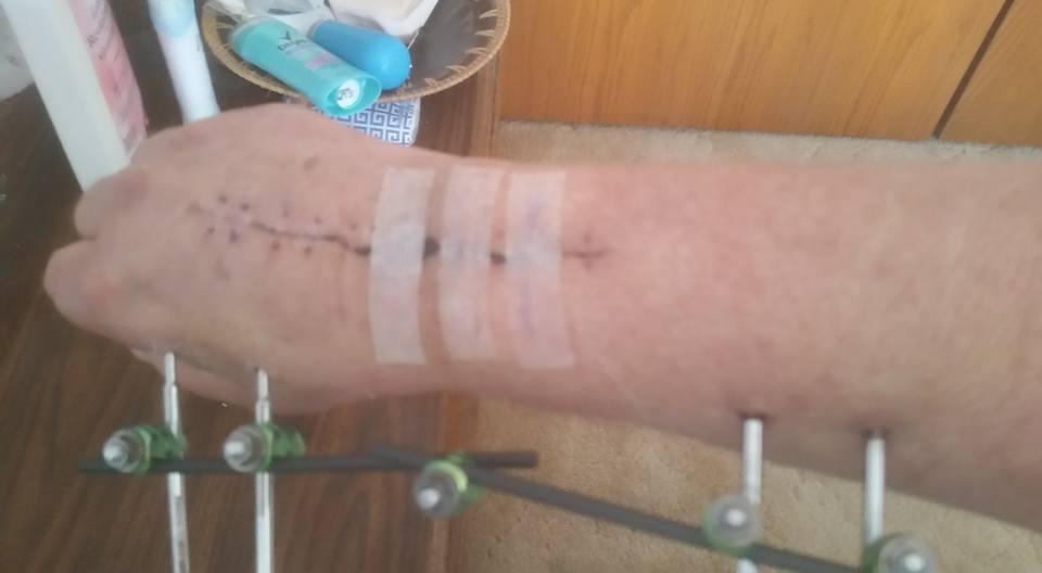 Posts are finally out after 9 weeks of it.  Glad it's all over with.  Infection all gone as well.  The use of my hand and wrist are so much better then it was prior.  Had an awesome surgeon.