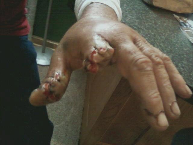 Jack Kinder's album, index finger and thumb