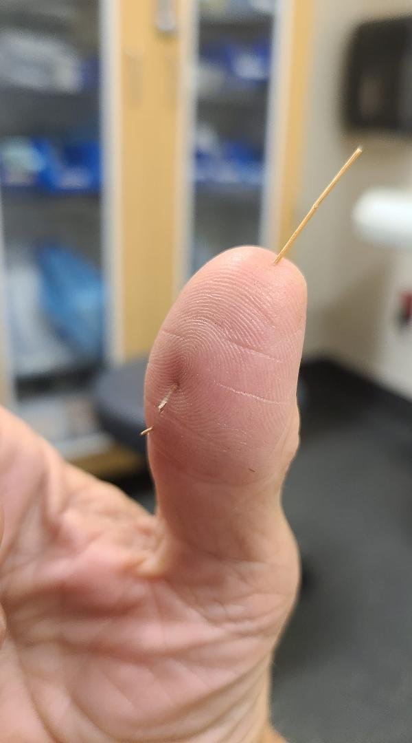 Waiting to be seen for huge splinter removal. What is it from? A browned Watsonia leaf. 😜🤯