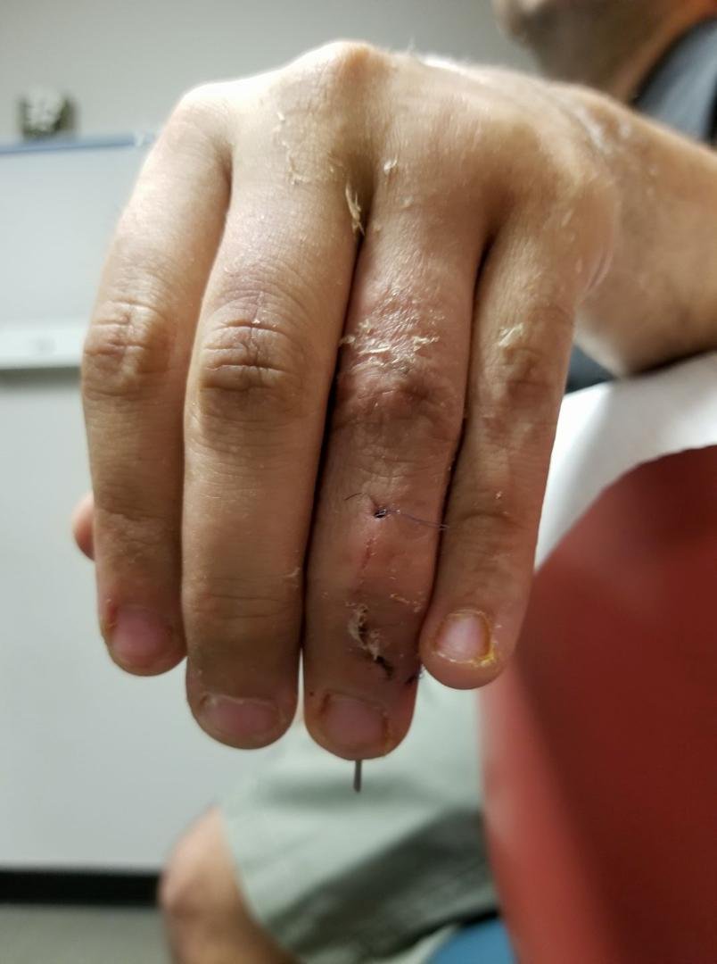 Forgot to post on Monday. His finger with out cast. Is back on, pin still in & 2 more weeks. Then (I hope) his last hand apt.