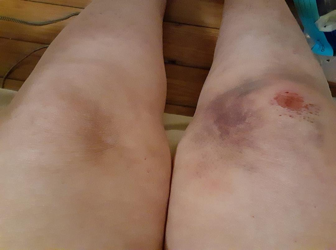 Asking for prayers and speedy recovery. I have fallen 3 times in 3 days. Nothing broken or torn just very bruised and sore. Having to wear a knee stabilizer brace for awhile.