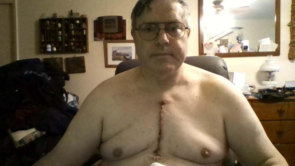 In case anyone is curious what an open heart sugery scar looks like on me, here it is. My apologies in advance if this grosses anyone out.