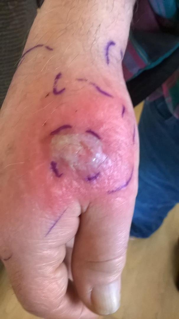 Anyone know what a treatment for this is? We went to the Urgent Care in Sequim last night, and all they did was mark the perimeters with a special body marking pen and give him a prescription for antibiotics. If it gets a