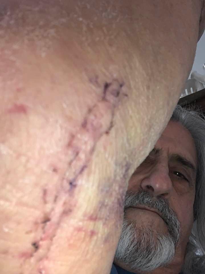 Stitches are out