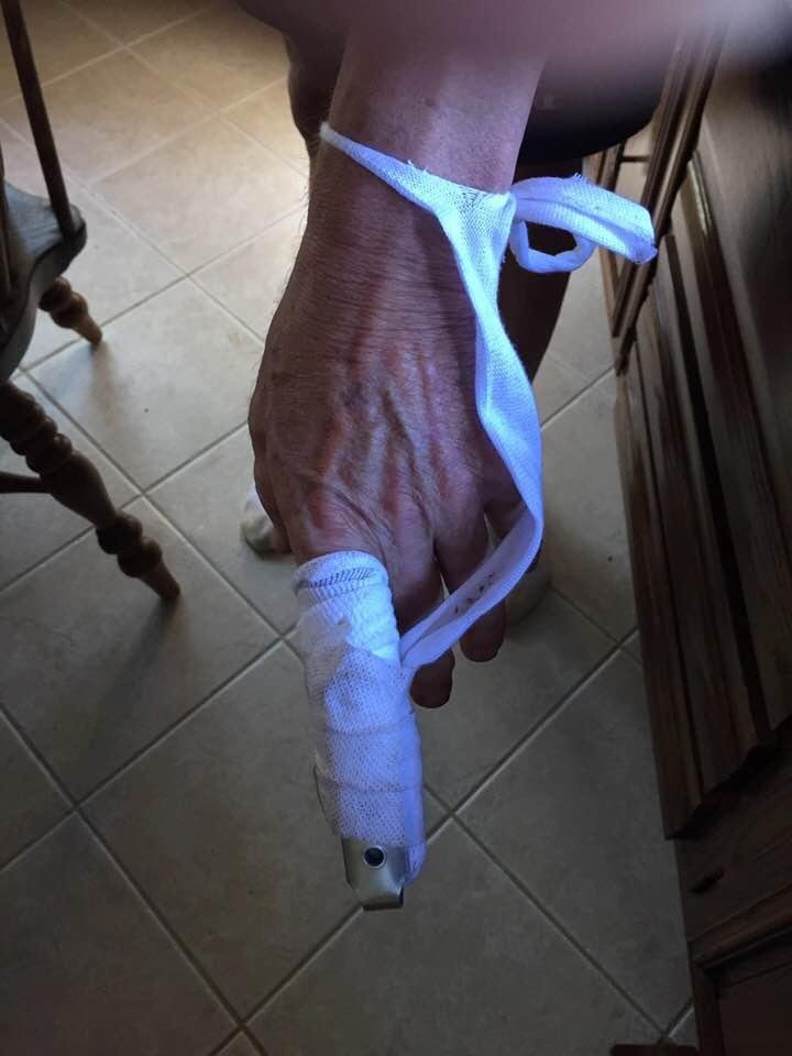 This is what happens when you leave a husband alone with a saw:North Memorial visit. He tried to cut off his finger instead of wood.
