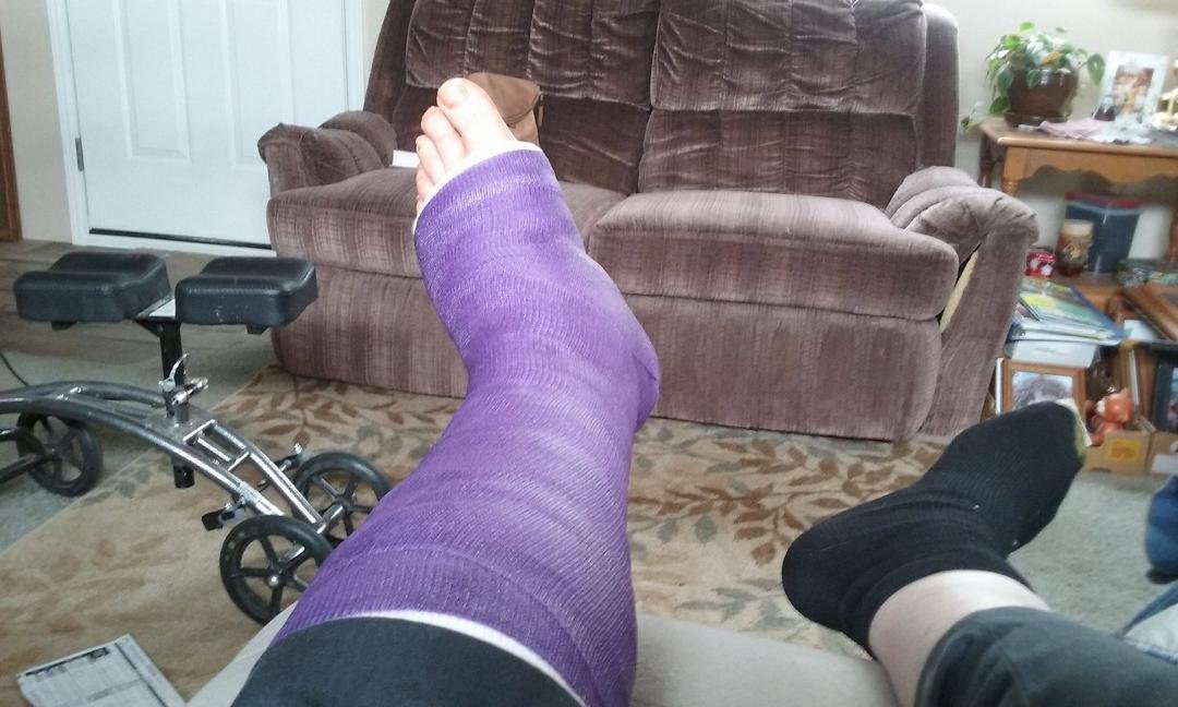 My beautiful cast never let it be said you can't fall for you spouse twice, thank you Diana Nydell Murphy cor being my nurse my friend, and beautiful wife love ya