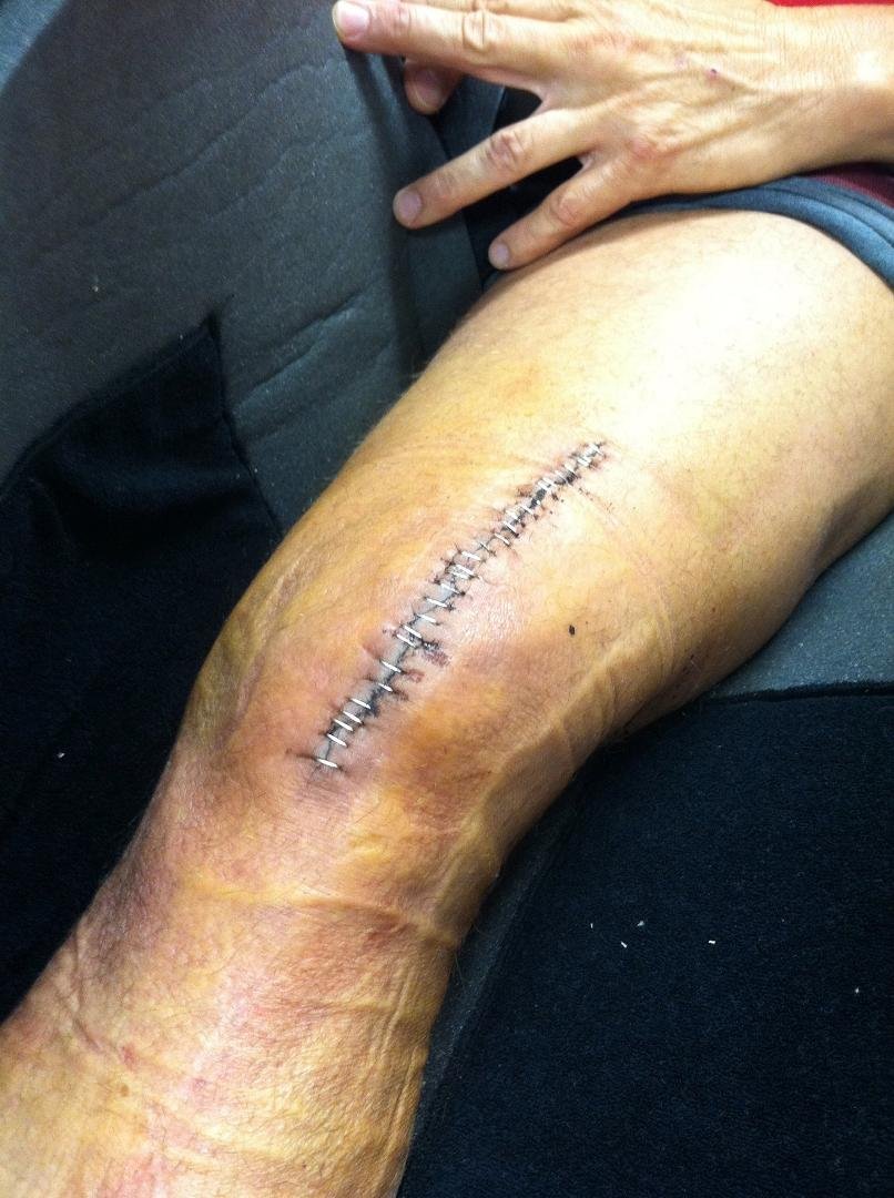 After some deliberation I'm leaving the physical therapy rehab facility Saturday. I can be as bored at home as I can be here. In house therapy from now on.
Left leg on 6/18, right looks the same.