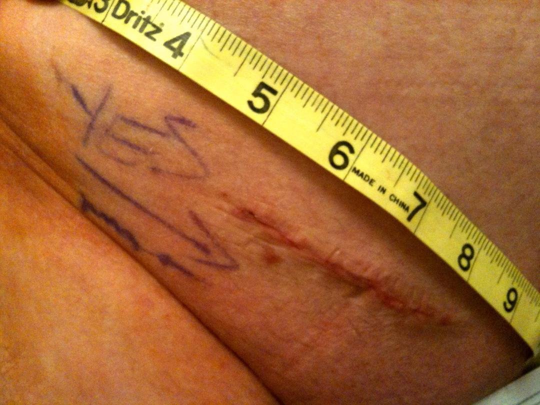 Here is the incision two days after I had hernia surgery. They glued it together--no sutures.