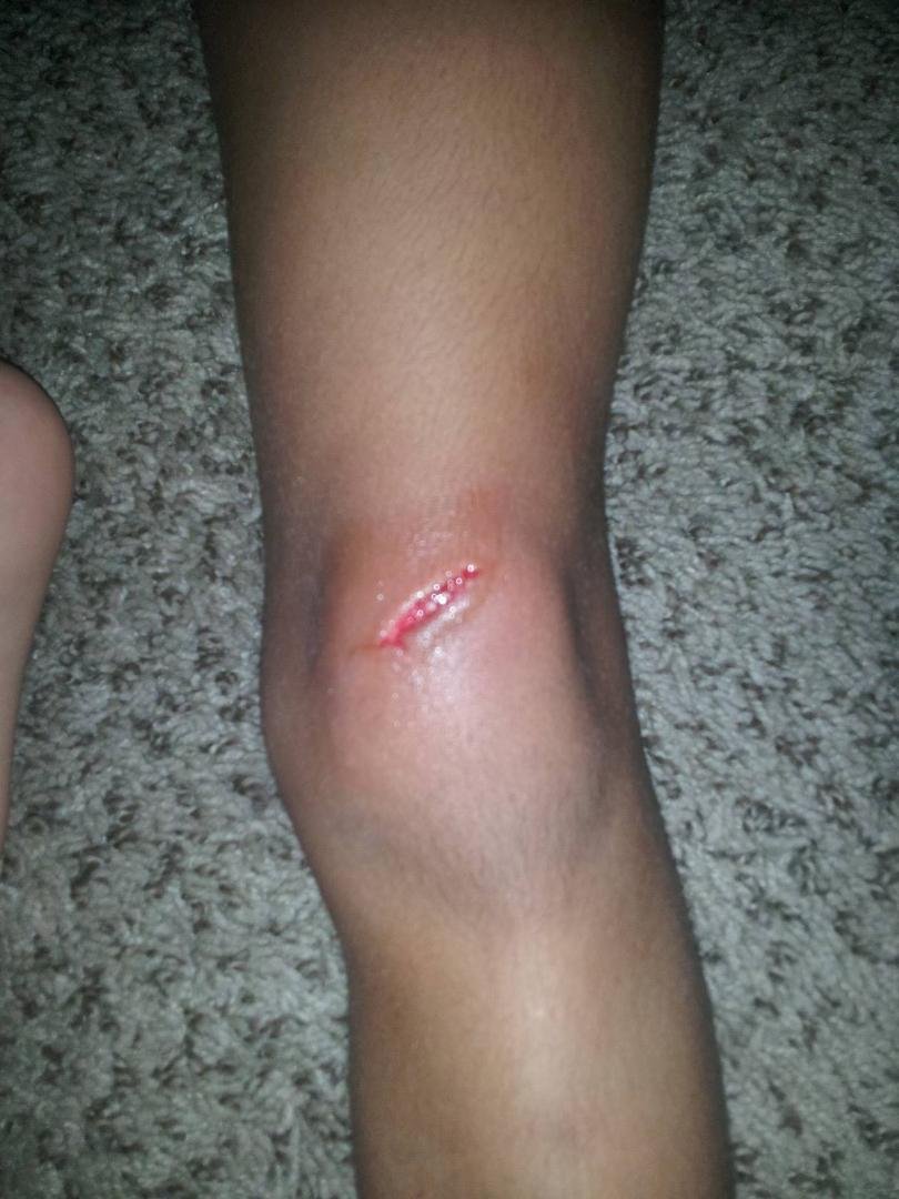 Nice cut on Ahmya's knee