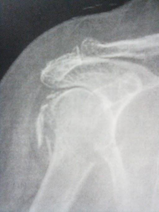 My very complicated fracture. It is fractured on the long bone just below the ball plus all the little pieces off to the left.