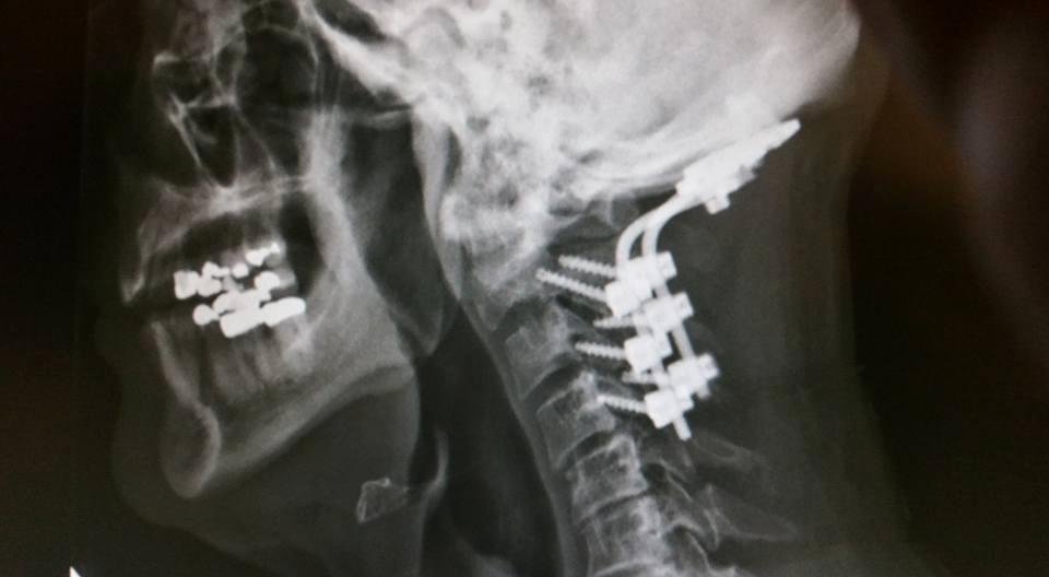 Not good when you want to keep your head on straight if the Dr says...... " you have a screw loose"