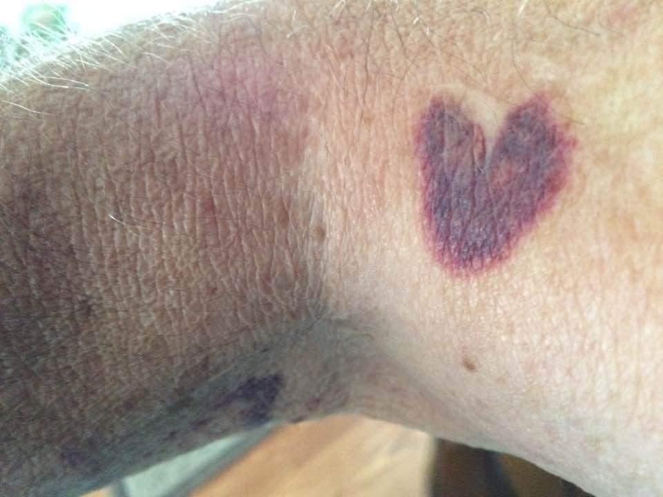 I don't know if HE is telling me something, but this heart appeared on my arm. The medicine that I have for an autoimmune problem results in random blotches on my arms, but never in such a definitive figure.