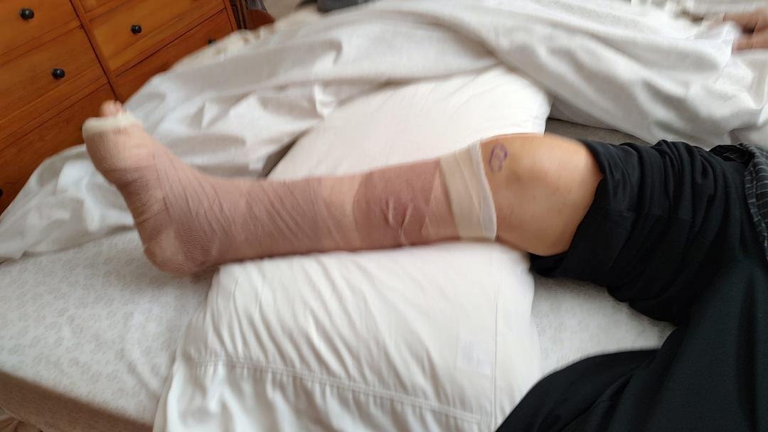 Two weeks ago I broke my ankle in three places. Today Dr Orlando did surgery to repair my ankle with a plate and screws. Looking ahead to a few weeks of recovery. A special thank you to the doctor and his assistants, Great