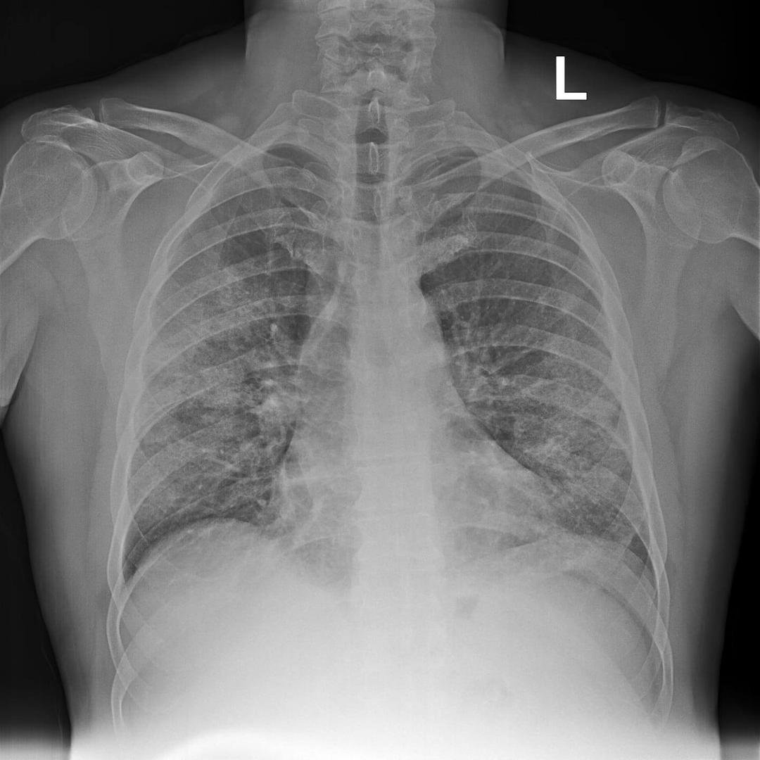 Covid19 full blown bilateral multifocal. If you really still think this virus doesn't exist, come over for dinner. Let's talk about it. STAY HOME.