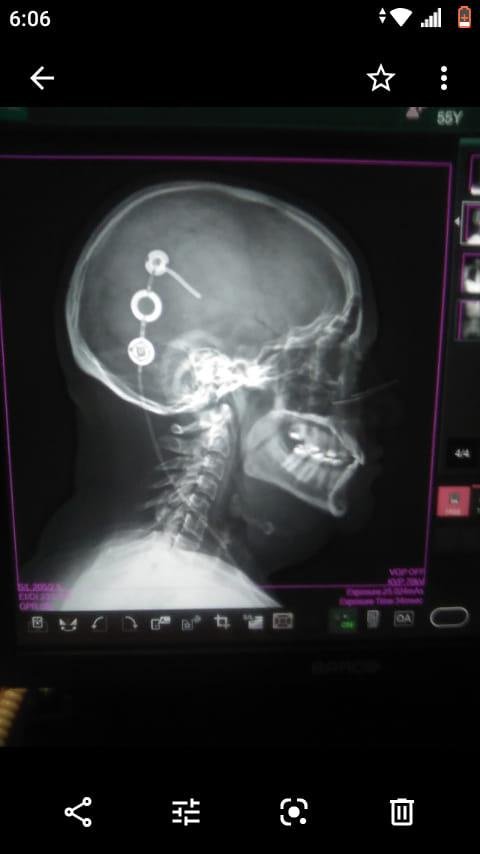 This is an x-ray of my head with the shunt.