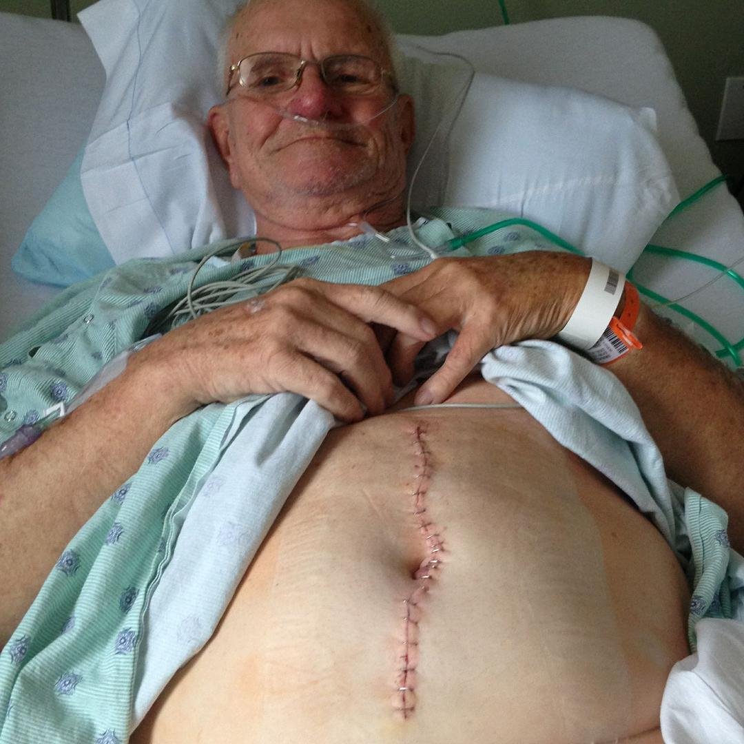 Going through old pictures. Thjs was right after my cancer surgery