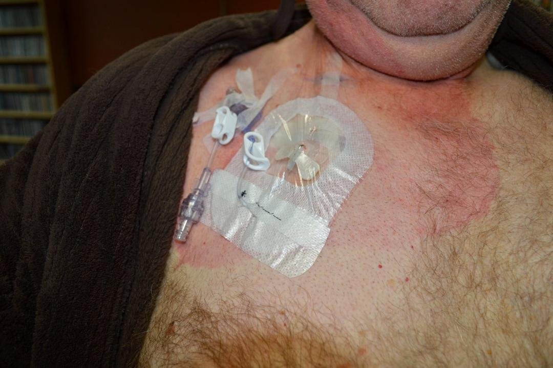 Getting ready for my next adventure in cancer treatment, with my newly installed Port-A-Cath.