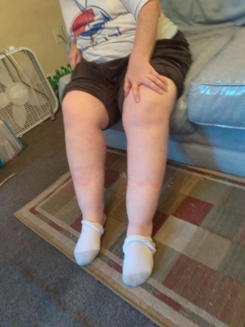 This is how swollen Karen's legs get after walking on them around for 4 hours.doing errands.