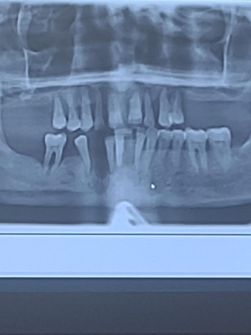 To my friends and family and anyone that will bless me. The bone that supports my teeth is gone there's nothing supporting my teeth. They flop around in the gum. I can only barely eat. The dentist is going to pull all the t