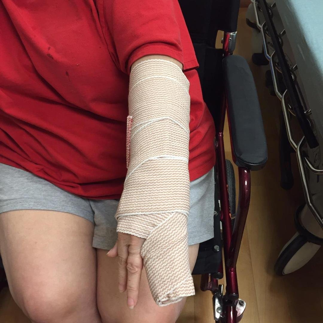 I broke my hand.