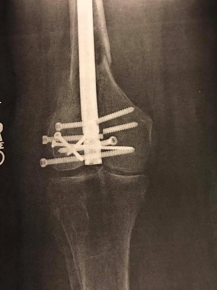 This is what I had going into surgery. What a difference 3 weeks make.
