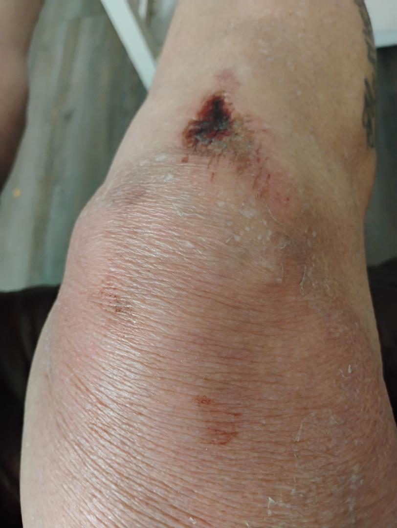They call me Grace....and it only happens to my right leg knee ankle or foot...I got this !!! LOL