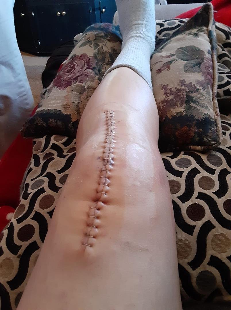 Day 4 looking better each time, still hurting but at least going forward not backwards