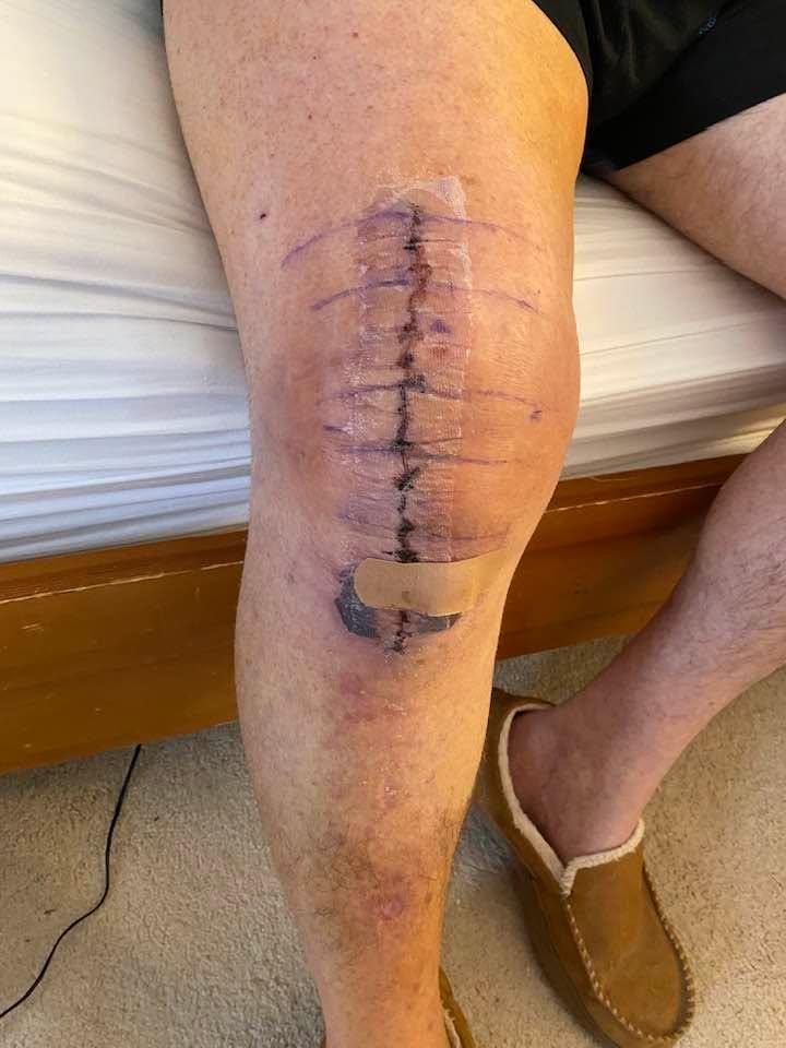 They say as the story goes, if there’s no pictures, it didn’t happen. So here’s the picture. I’m actually doing pretty well. I had my first real PT today. I feel pretty good after that. I’ll keep you updated.