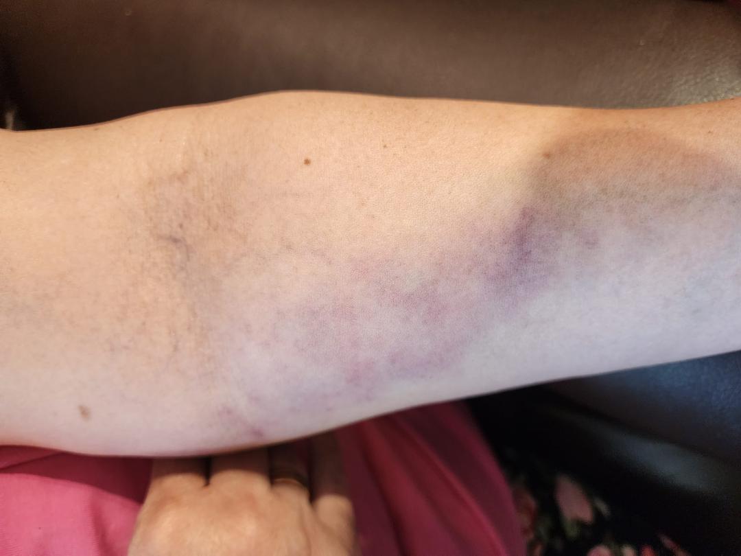 I still have this bruise and it is very tender even to run a finger.Over it. Ow