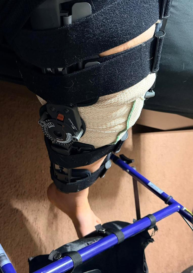 6weeks no weight bearing. Surgeon was able to reattach the miniscus to the bone instead of cutting it out.