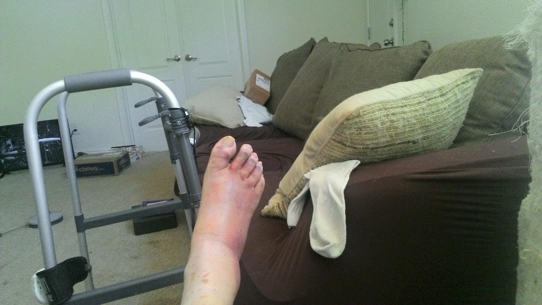 Day 8 of broken foot