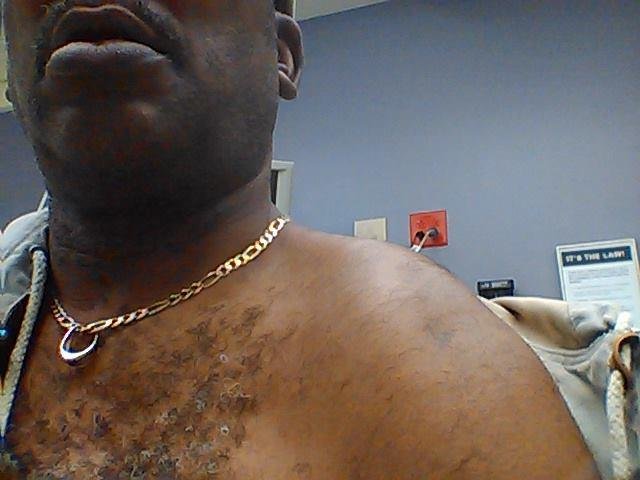 This is what happens when someone pulls out in front of you separated shoulder hurts like hell
