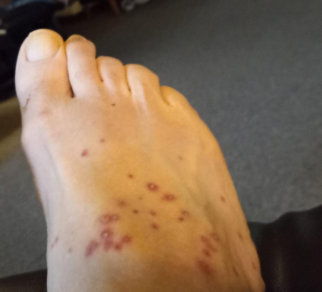 Glad I'm not allergic to fire 🐜.