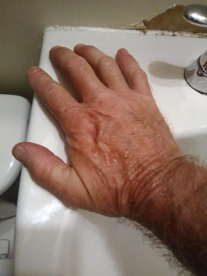 This is what a working hand looks like at 53