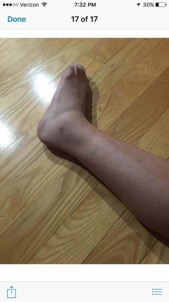 Feeling very sad for Jillian she was just days away from getting clearance to start goalie training, returning from a broken wrist. She was playing forward yesterday when a goalie from the other team recklessly sled into he