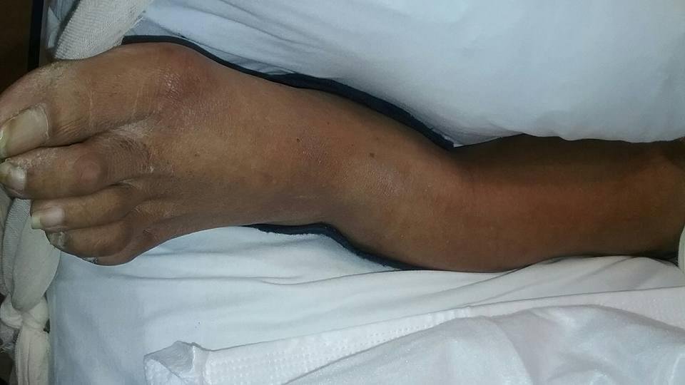I missed a step and broke my ankle (OUCH).Don't know yet but may need surgery.
