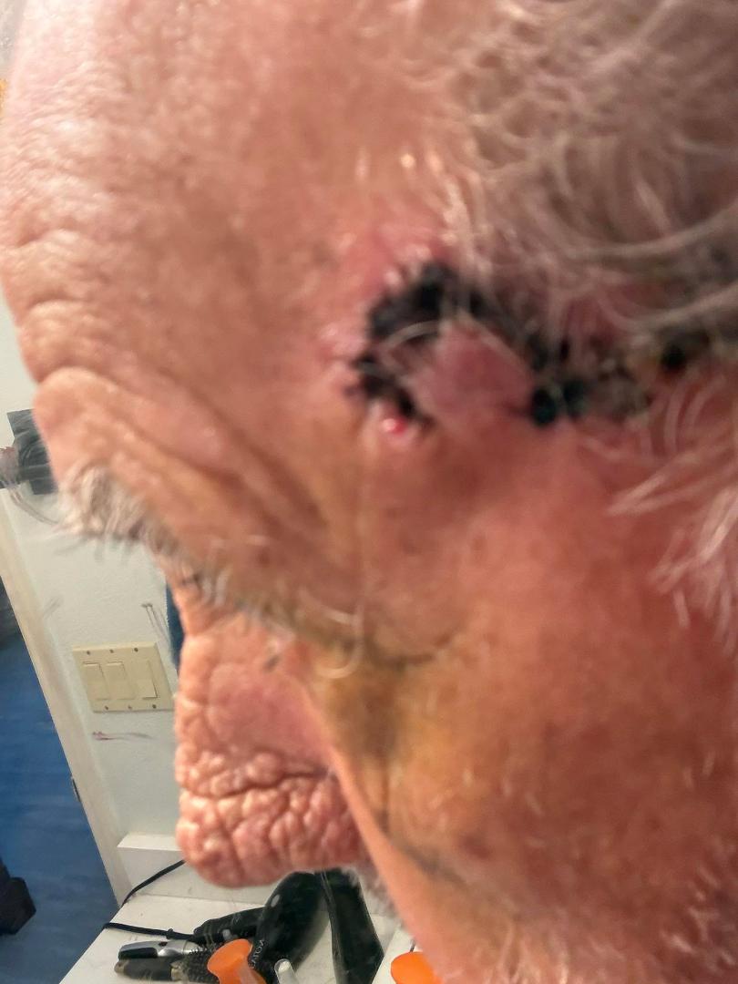 Squamous carcinoma removed last week and I go tomorrow to have stitches out. Hope it doesn’t ruin my movie career lol