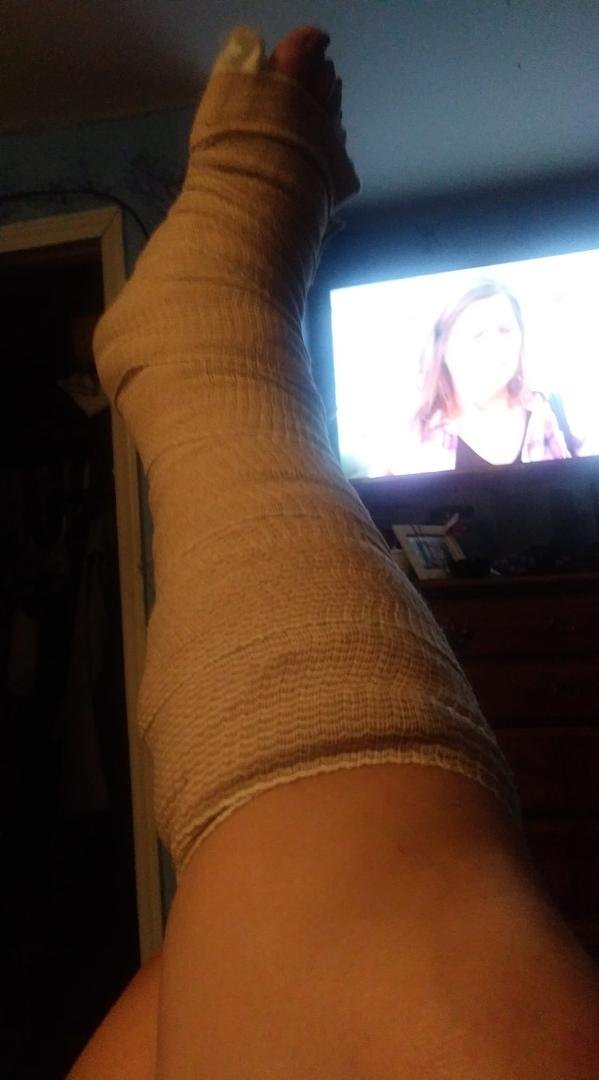 This is what happens when i get in too big of a hurry and its dark and i had a bag of ice in your arms.BROKE MY FOOT.,THE BONE WAS STICKING OUT OF MY FOOT.i had surgery and my foot is in a cast ,hopefully healing back right