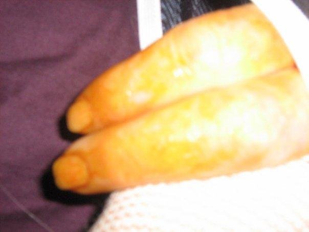 INDEX FINGER AD MIDDLE WERE LEFT OUT, BUT WERE SWOLLEN.