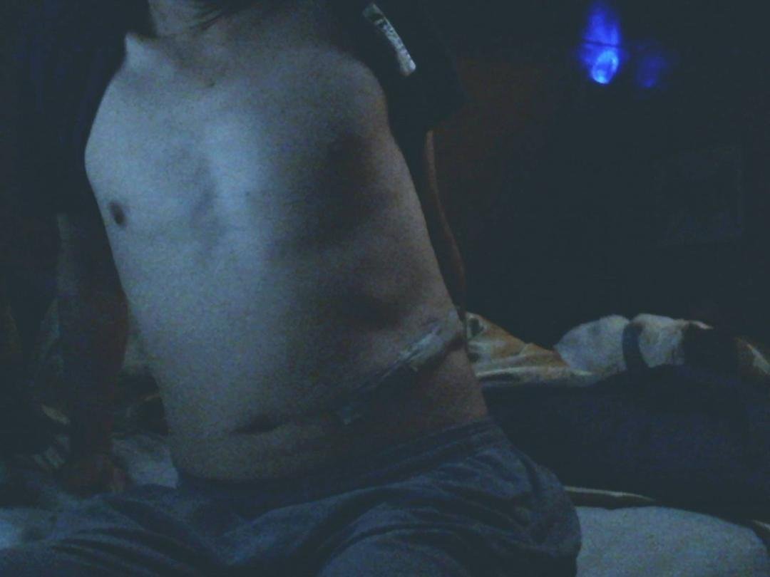 Hi everyone!!! I'm still recovering from that nasty op. they did on me. I'm still in a lot of pain but slowly getting better. here's a pic. as of today.