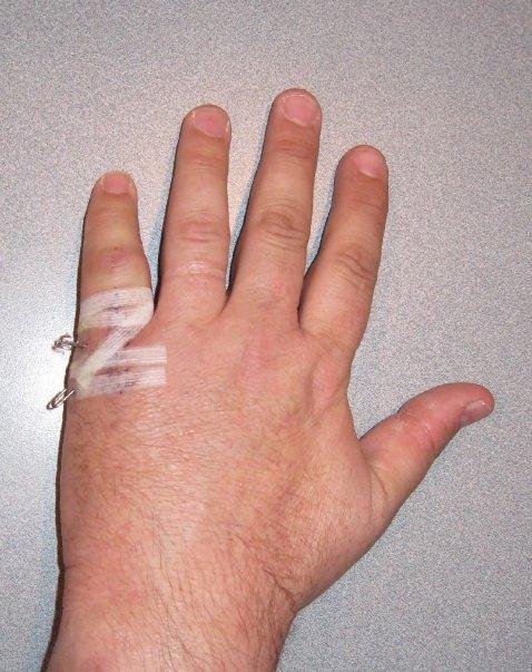 Metal pins 1 - look how fat that finger is...