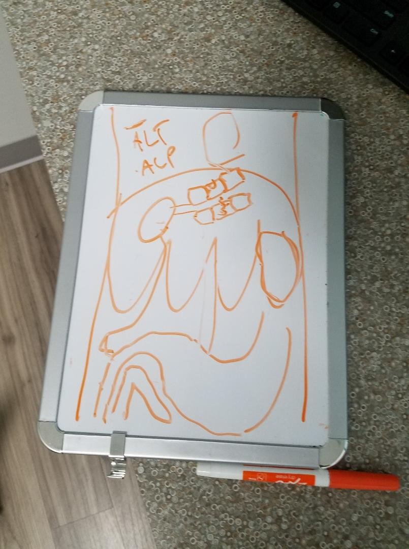 El Dr. dibujo el cuerpo de Ewok para explicar como funciona el higado por que sus niveles d higado estan muy altos.