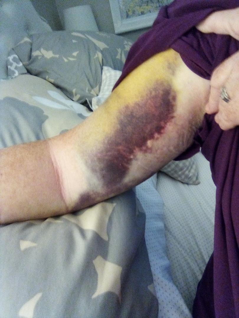 I tripped Wednesday night and fractured my upper arm. This is what it looks like today.