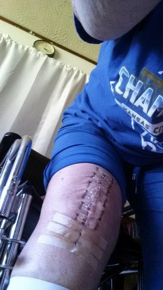 Day 13 after surgery with the new Zip - Tie method. No puncture wounds to the skin as with stitches or staples. Zip Tie comes out on Wednesday of this week.