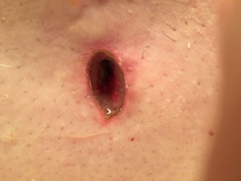 Woke up November 7 with the sensation that I swallowed a basketball. Drove myself to the local Parkview Emergency Clinic. A quick exam and an ambulance ride to Parkview Main and surgery. Four incisions. Two sealed shut. One