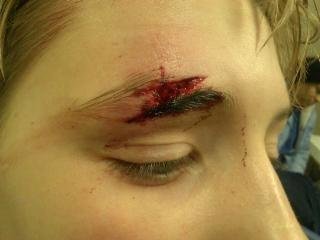 chances eyebrow 7 stitches