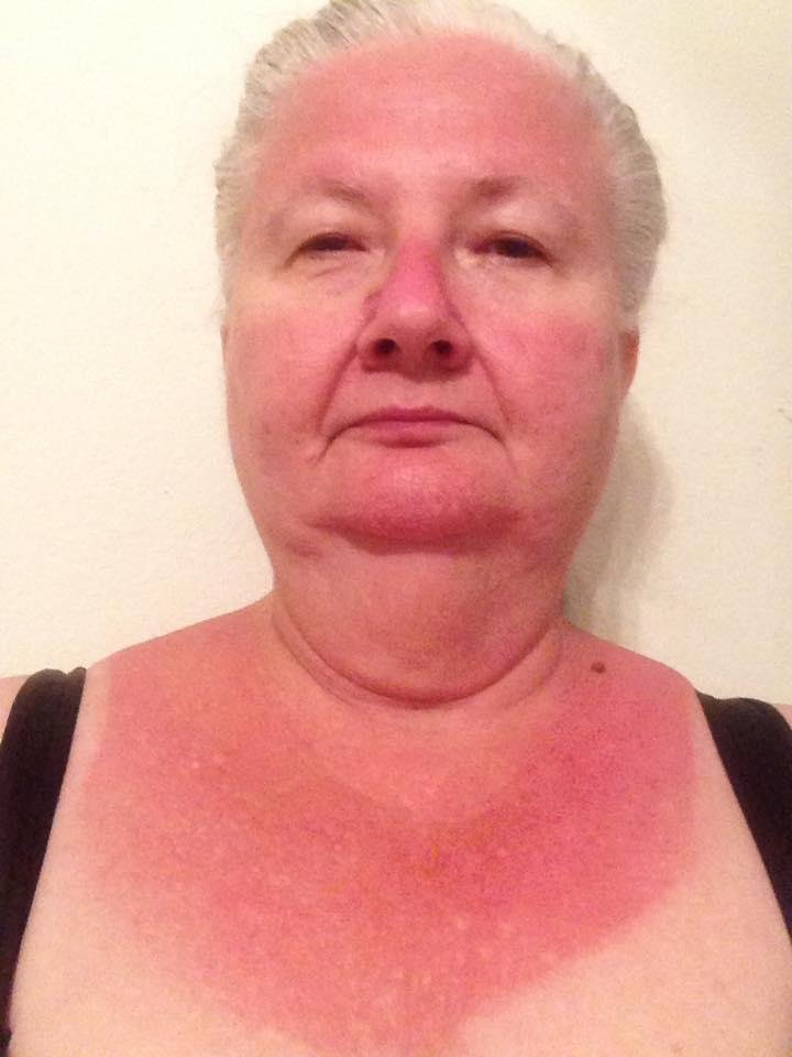 So it at least looks like I had a hot time!! Burned to a crisp🌞🔥😎
