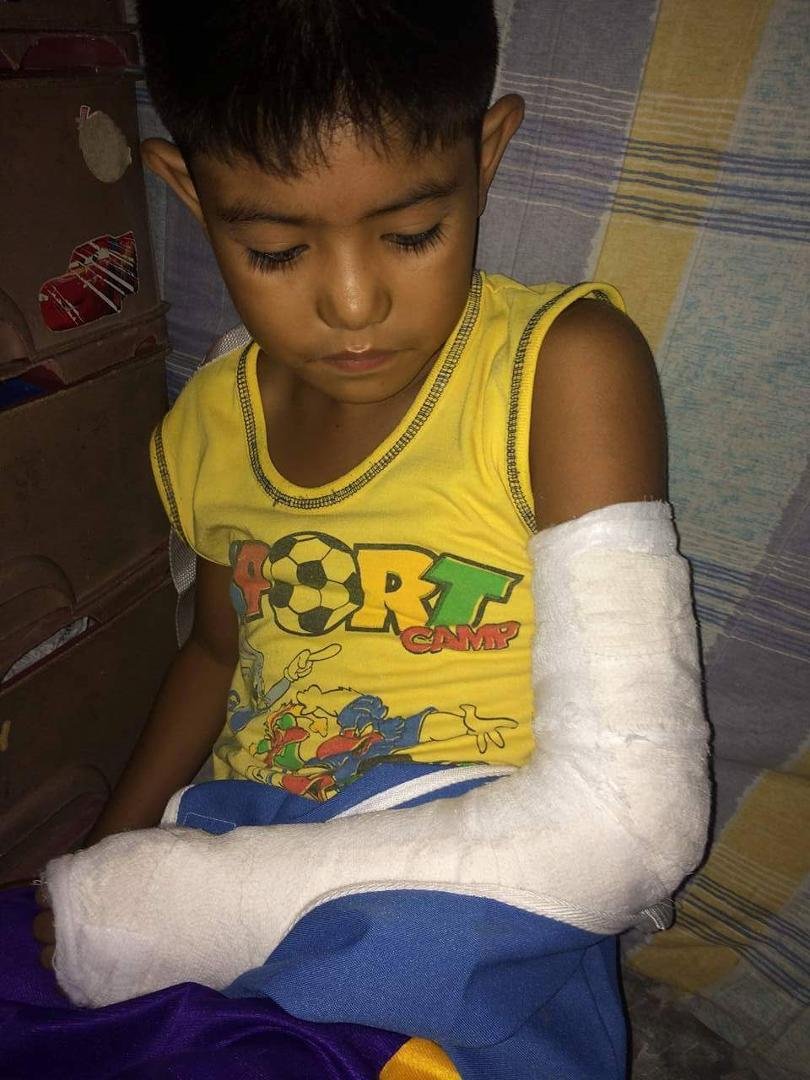 Vince broken arm