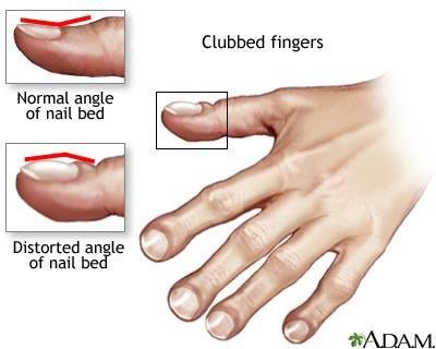 Fingers with IPF (clubbing)